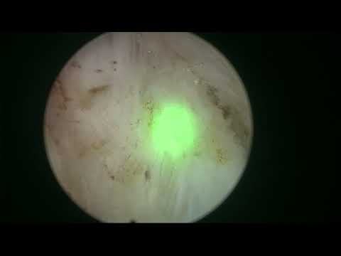 Real life MoLEP 18 - Big Prostate with MOSES