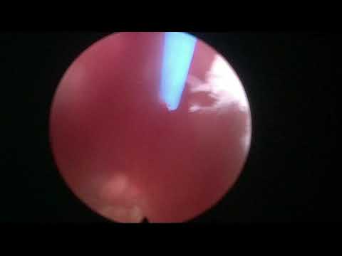 Real Life HoLEP case nº 15: trilobar prostate with narrow urethral lumen