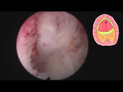 En Bloc MoLEP with early apical release, step by step