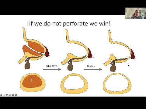HoLEP Difficult Cases — Tips and Tricks for Challenging Prostates