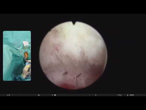 En bloc HoLEP for a massive prostate 500 cc. Unedited Full Case