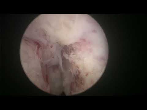 Real-life En Bloc MoLEP (MOSES 2.0 HoLEP) case 29: tricky start and a big beach ball at the end