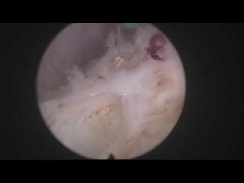 Real life MoLEP case 24: nice trilobar fast case