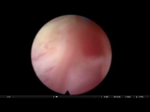 9 Consecutive HoLEPs in One Day — Real Life Series from Sofia, Bulgaria