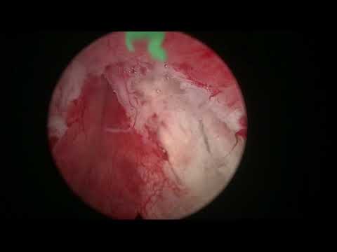 Real-life HoLEP case number 7: Refractory retention-excellent explanation of early apical dissection