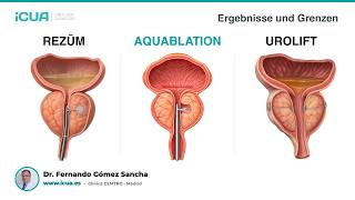 Rezūm, UroLift und Aquablation: Was Sie vor der Entscheidung wissen sollten