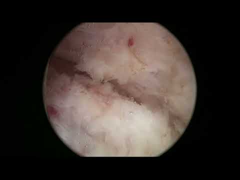 RLHoLEP Case 35: En bloc Virtual Basket HoLEP 400 grams