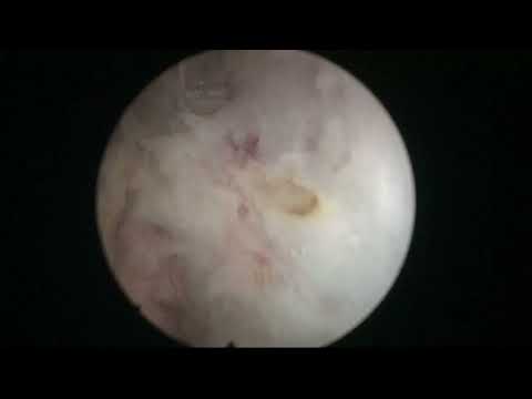 RL HoLEP case 44: a nice recapitulation of surgical steps after some years