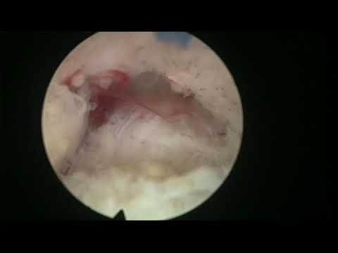 Real life HoLEP case number 3: hypervascular large prostate