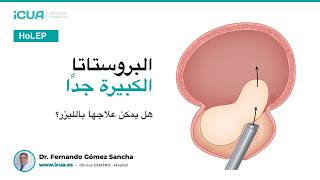 البروستاتا الكبيرة جدًا: هل يمكن علاجها بجراحة HoLEP؟