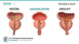 Rezūm, UroLift e Aquablation: cosa sapere prima di decidere