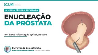 HoLEP em bloco com libertação apical precoce - A minha técnica explicada