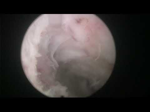Real life Virtual Basket HoLEP. Case 27: obese patient with 190 cc prostate.