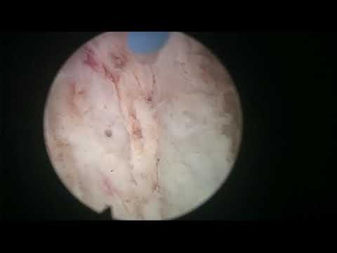 Real-life HoLEP 16: A man with rigid hips