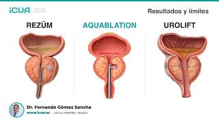 Rezum, UroLift y Aquablation: qué saber antes de decidir