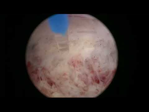RL HoLEP case 42: Small prostate, bad plane