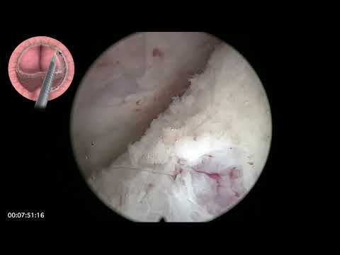 RL HoLEP case 36, presented at Urotech Congress in Istanbul, Turkey