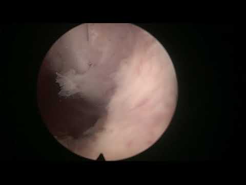 Real life MoLEP case number 10: large prostate (190 grams)  in retention
