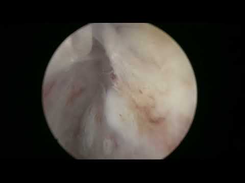 RL HoLEP case 44: En bloc HoLEP technique in an anticoagulated patient