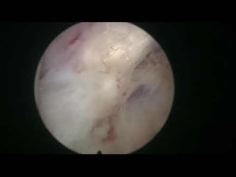 Real-life MoLEP cases: Case number 6 - a biggish 160 cc prostate