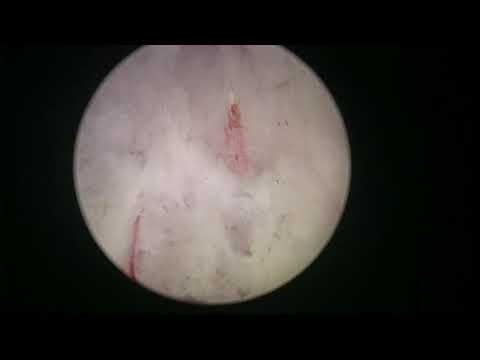Real life HoLEP case number 2: Redo case after GL vaporization 10 years ago
