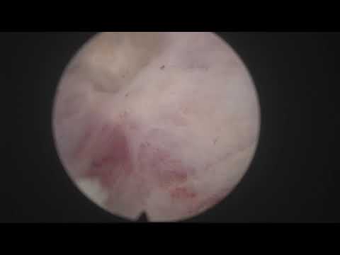 Real life MoLEP case 23: Redo after TURP with stone in diverticulum