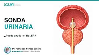 Sonda urinaria por próstata grande: ¿puede ayudar el HoLEP?