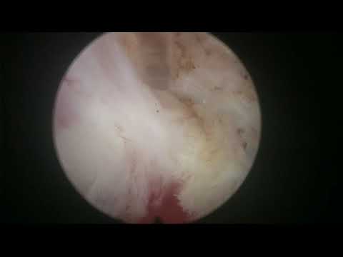Real life Virtual Basket En bloc HoLEP, case 25: nice surgical tips