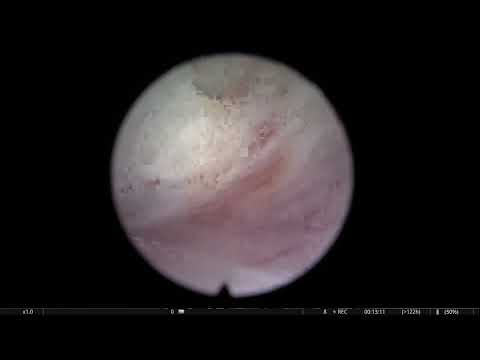 RL HoLEP case 41: Redo interesting case