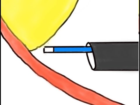 Real Life HoLEP #43: Surgical Trick for Difficult Cases — Christmas Edition