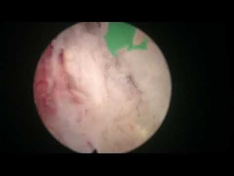 Real-life MoLEP cases: case number 8 - redo case after 2 TURPS