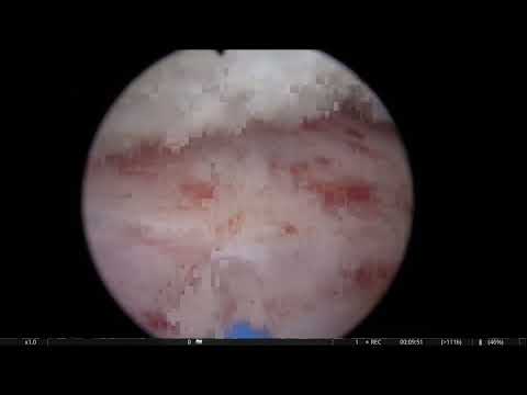 RL HoLEP case number 37: 400 cc prostate