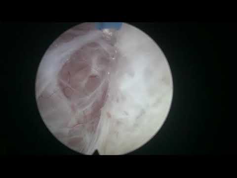 Real Life HoLEP 17 - peripheral zone BPH nodule