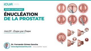 L'opération HoLEP étape par étape