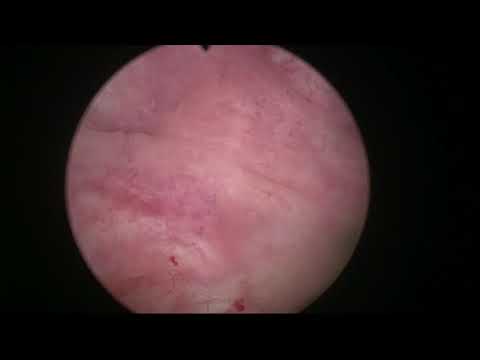 Real-life HoLEP 21: Diverticular bladder with stones