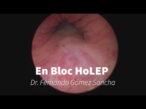 En Bloc HoLEP with Early Apical Release — The Gómez Sancha Technique (WJU 2019)