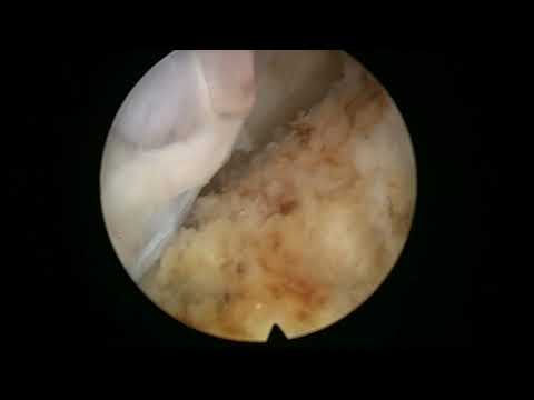 Real Life HoLEP Case number 31: HoLEP in a patient with prostate cancer
