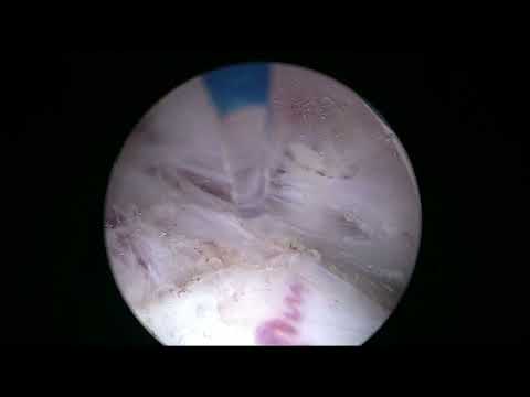 Real Life HoLEP #38: 90g Prostate in Elderly Patient — Full Surgery