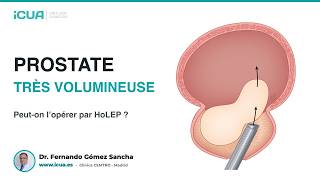 Prostate très volumineuse : peut-on l’opérer par HoLEP ?