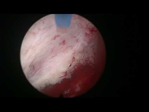 Real life HoLEP case number 13: A bulky prostate with a tendency to bleed more than usual