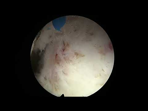 Real Life HoLEP #40: 250g Giant Prostate — Unexpected Intraoperative Findings