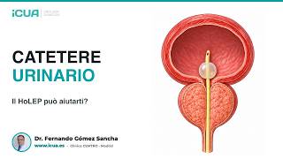 Catetere urinario e prostata ingrossata: quando può aiutare la HoLEP?