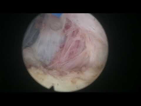 Real-life En Bloc HoLEP case 28: Re-do after GreenLight vaporization