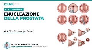 L'operazione HoLEP passo dopo passo
