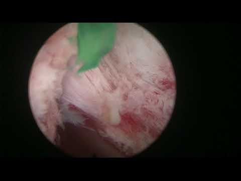 HoLEP en bloque con liberación apical precoz. Caso 5