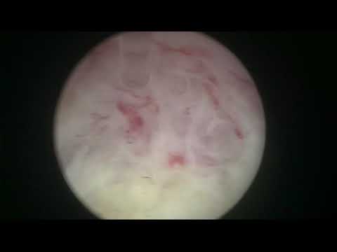 Real life Virtual Basket en bloc HoLEP, Case 26: big prostate, in retention, high PSA