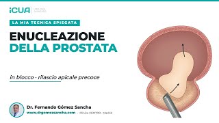 HoLEP in blocco con rilascio apicale precoce: la mia tecnica spiegata