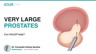 Very large prostates: can they be treated with HoLEP?