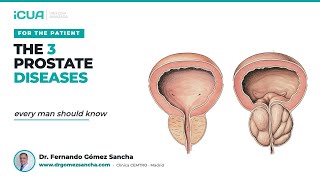 The 3 Prostate Diseases Every Man Should Know About