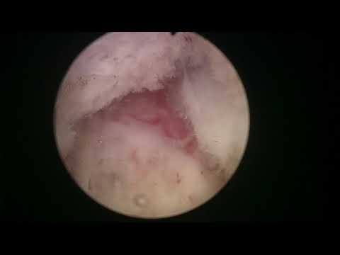 Real life HoLEP case number 1: MOSES 60 g prostate
